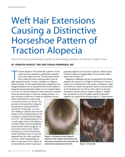 T Weft Hair Extensions Causing a Distinctive Horseshoe Pattern of