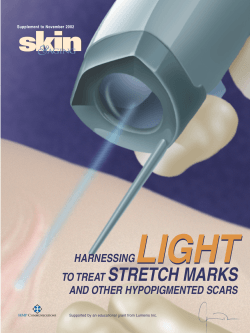 LIGHT skin STRETCH MARKS &amp;