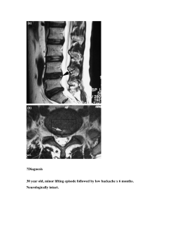 ?Diagnosis 30 year old, minor lifting episode followed by low backache... Neurologically intact.