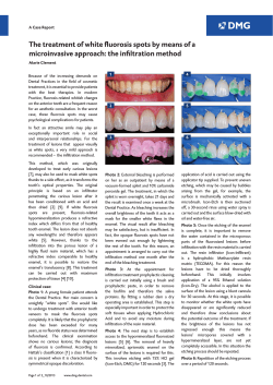 The treatment of white fluorosis spots by means of a