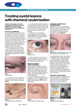o t Treating eyelid lesions with chemical cauterisation