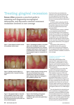 Treating	gingival	recession