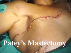 Patey’s Mastectomy