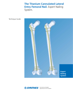 The Titanium Cannulated Lateral Entry Femoral Nail TG