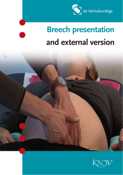 Breech presentation and external version
