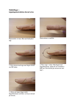 Malletfinger – tejpningsinstruktion dorsal ortos